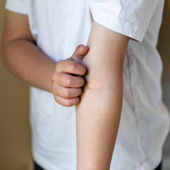 AD_ATOPIE_CHILD-SCRATCHING-ARM_LARGE_2021