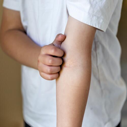 Eczema atopico: alleviare il prurito