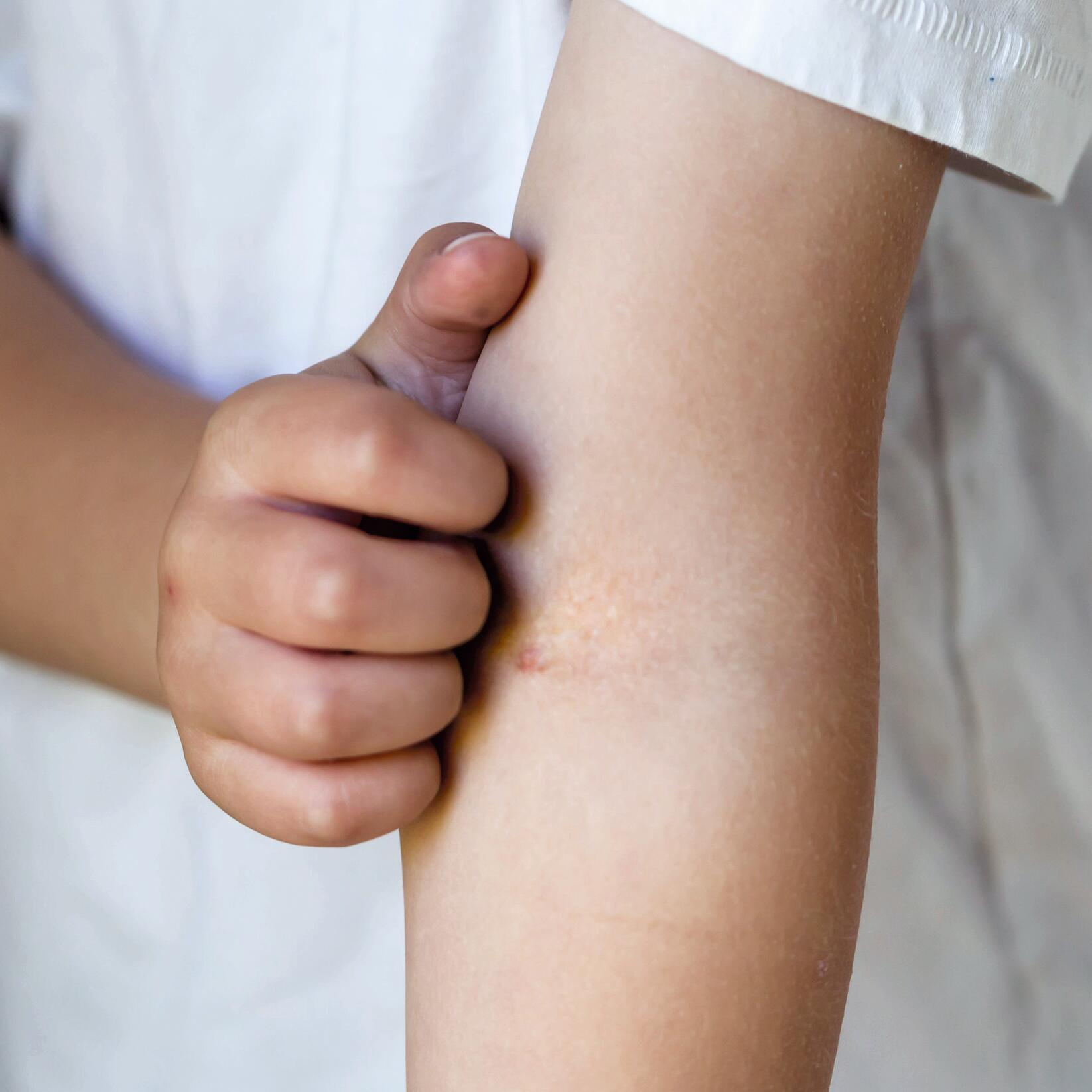 AD_ATOPIE_CHILD-SCRATCHING-ARM_SQUARE_2021