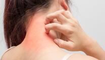 du_dexyane-med_silo_eczema_l2-area_p7-neck-eczema