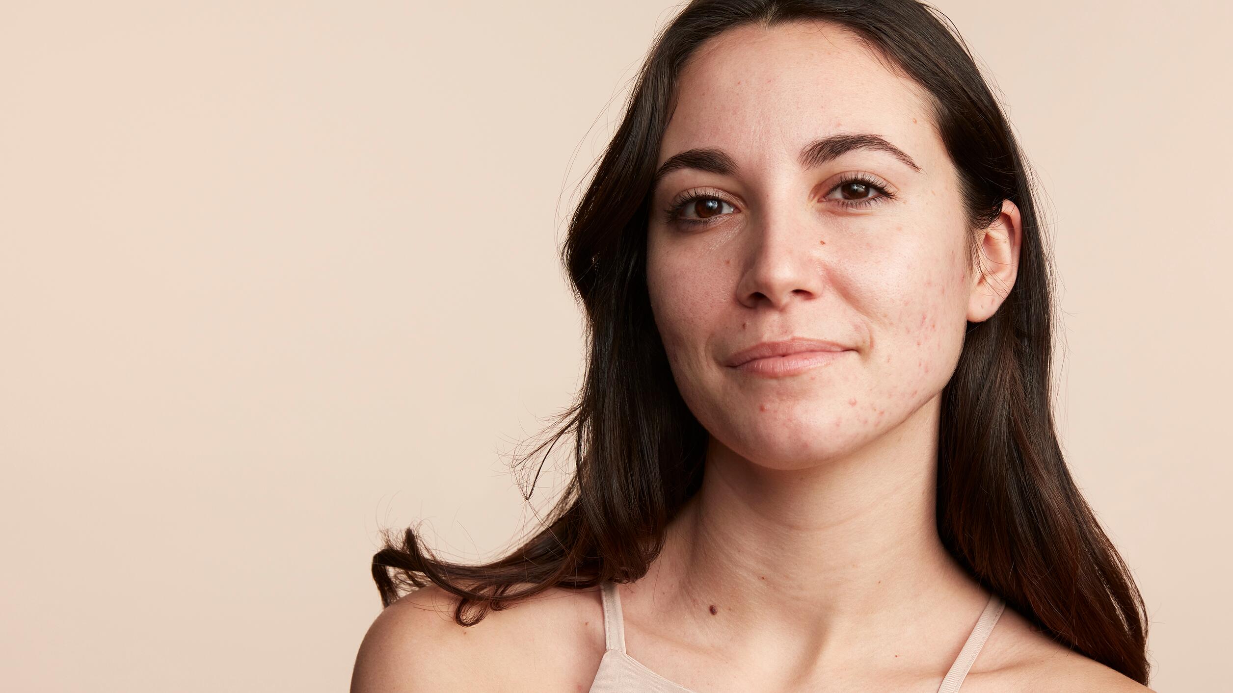 av_couvrance_before-after_lola-acne_before_bd_16-9