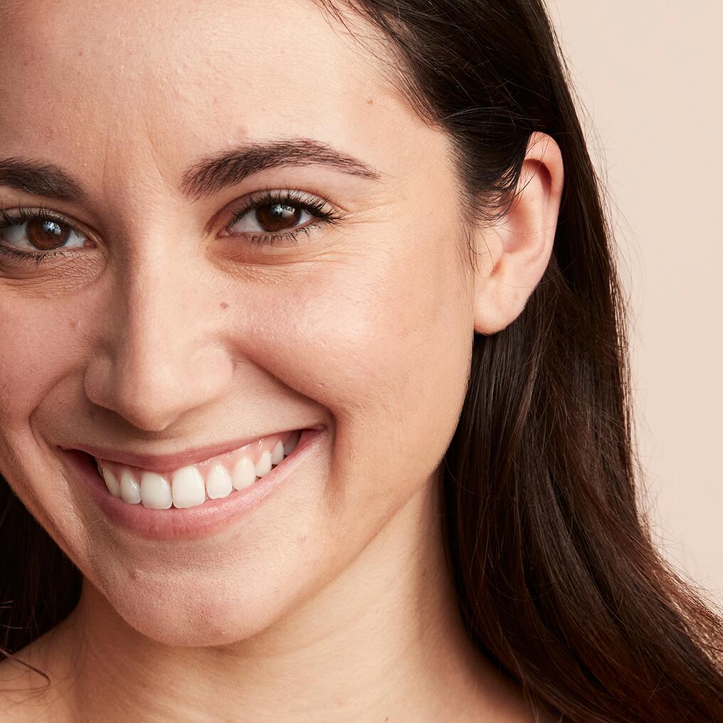 av_couvrance_before-after_lola-acne_after_bd_1-1