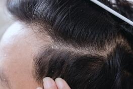 Seborrheic dermatitis