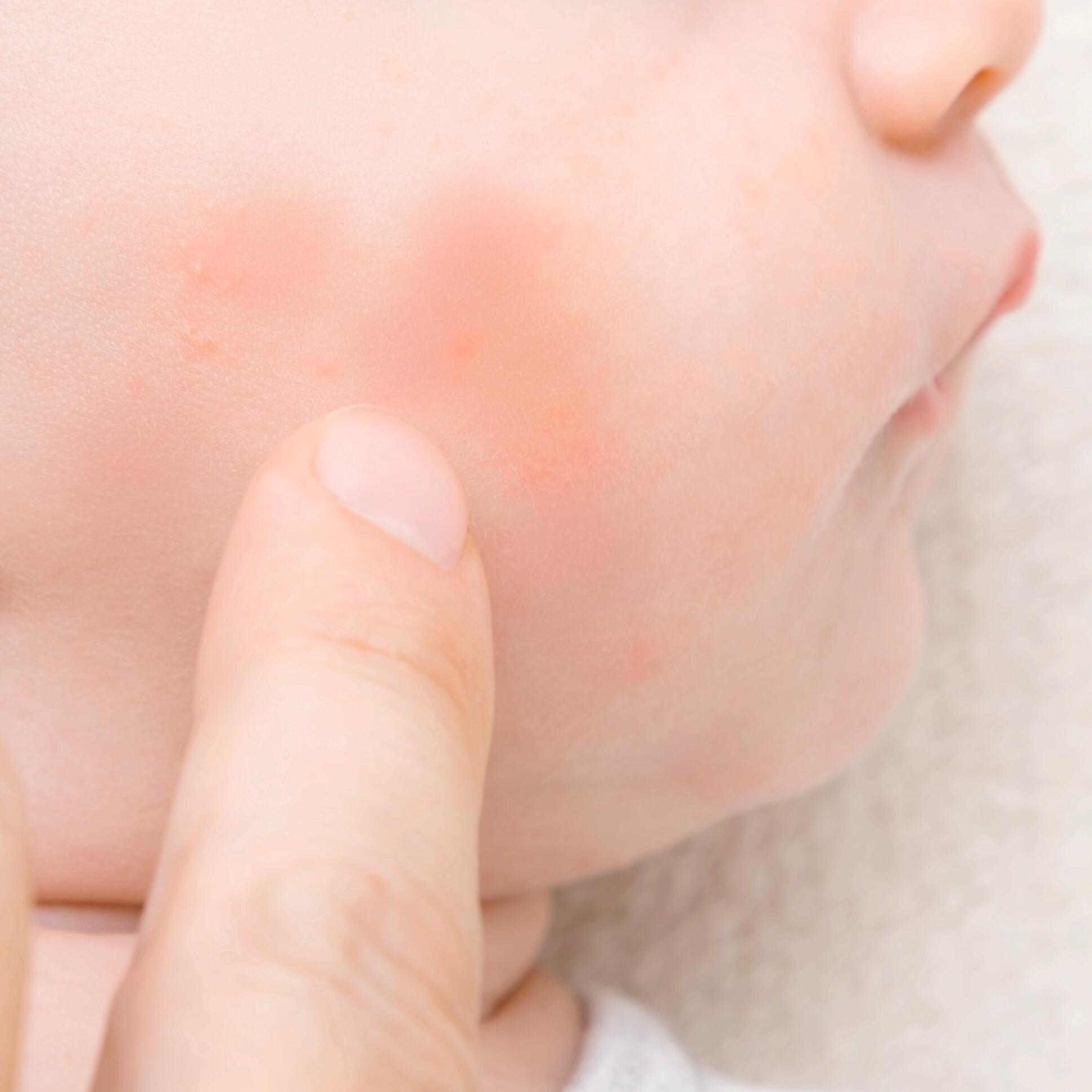 AD_IRRITATIONS_BABY-IRRITATED-RED-CHEEKS_SQUARE_2021