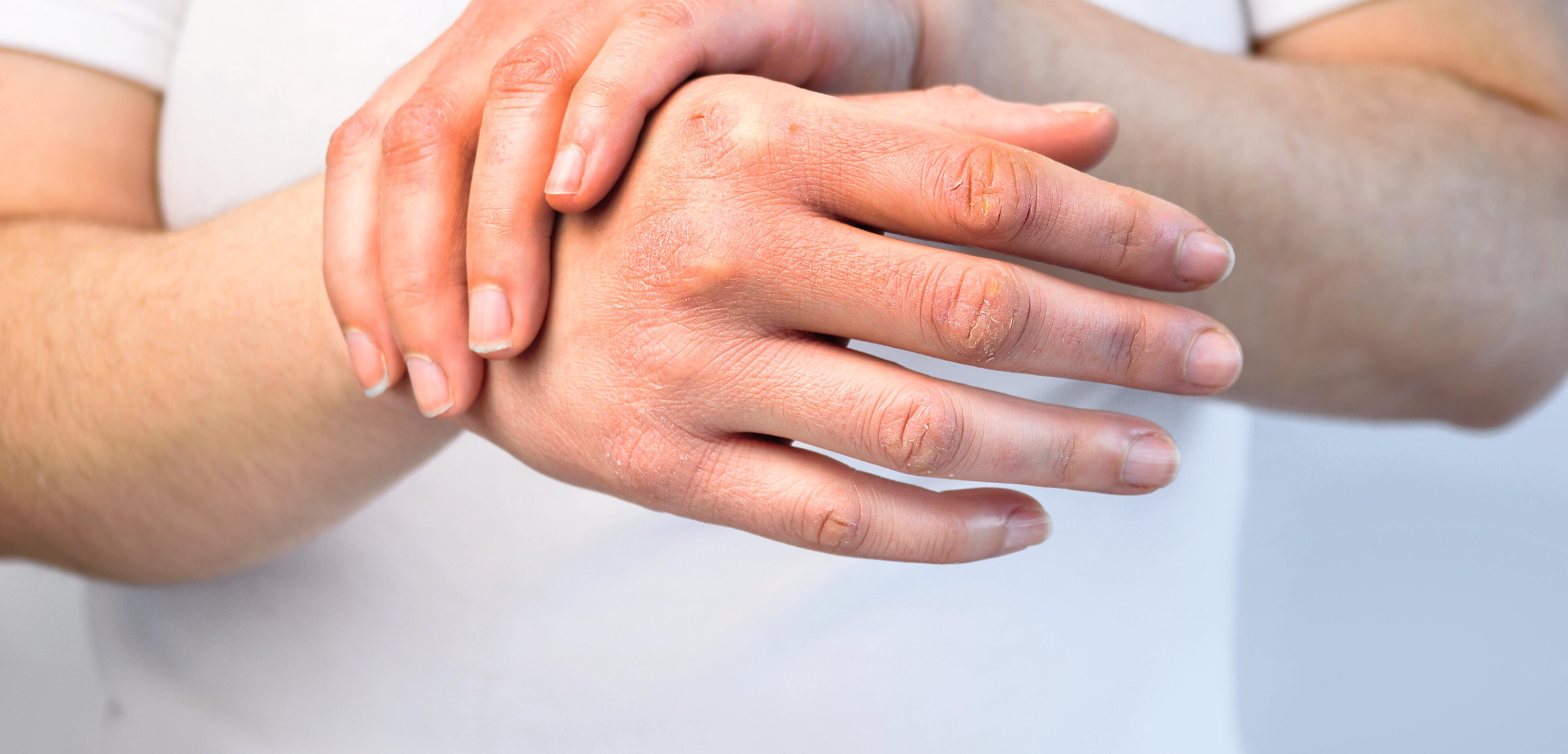 behandeling in de rij gaan staan Regelmatig Contactallergie, eczeem op de handen kalmeren | A-DERMA