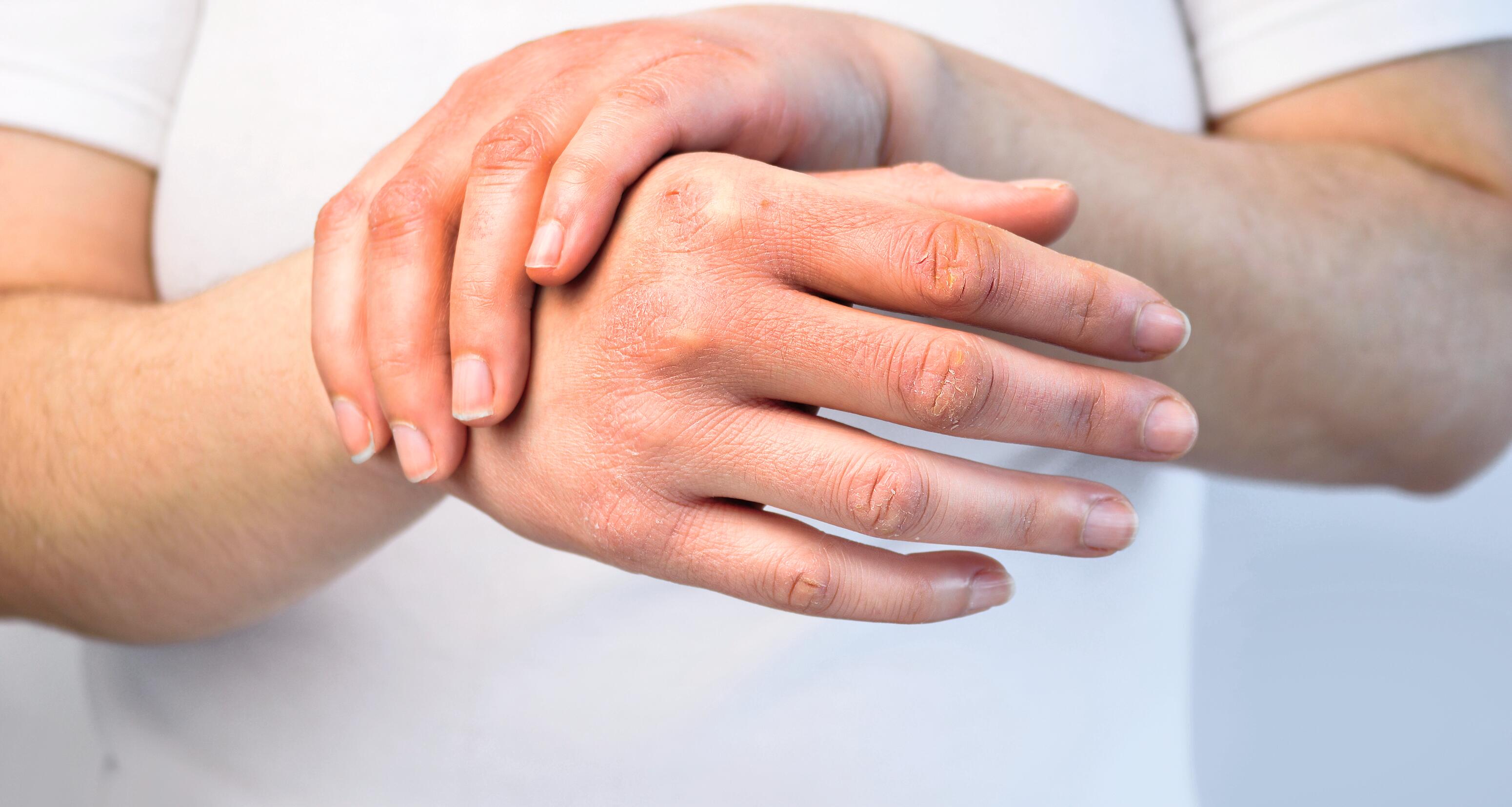 Eczéma des Mains : Causes, Symptômes & Traitement
