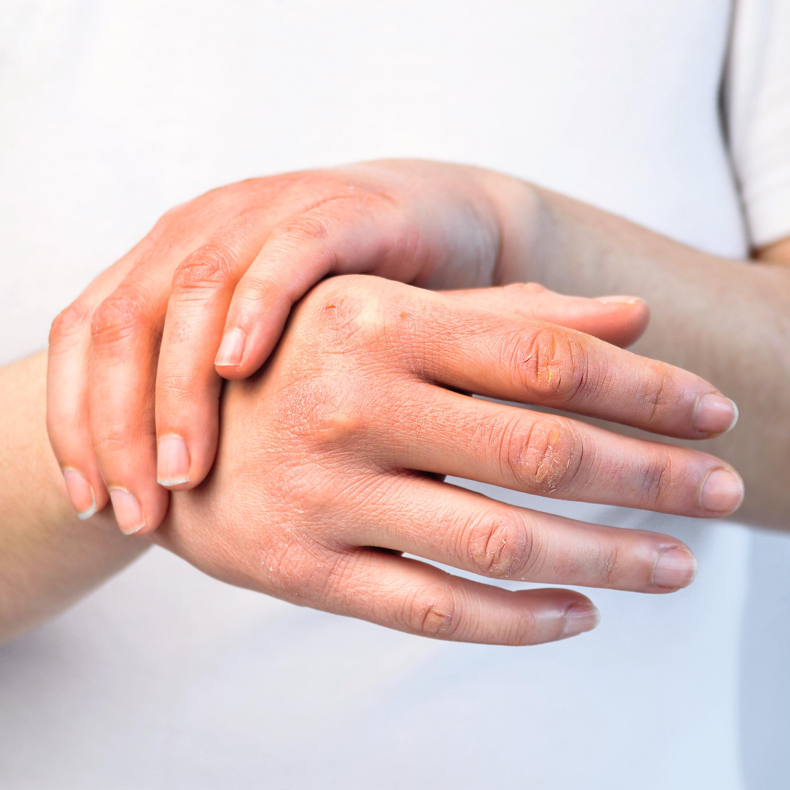 AD_IRRITATIONS_RED-HANDS_LARGE_2021 492x492