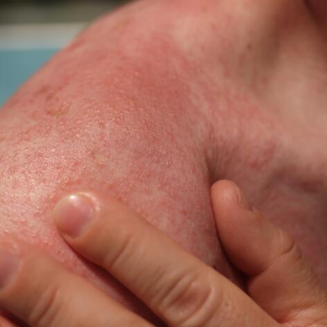There are two types of radiodermatitis¹¹: