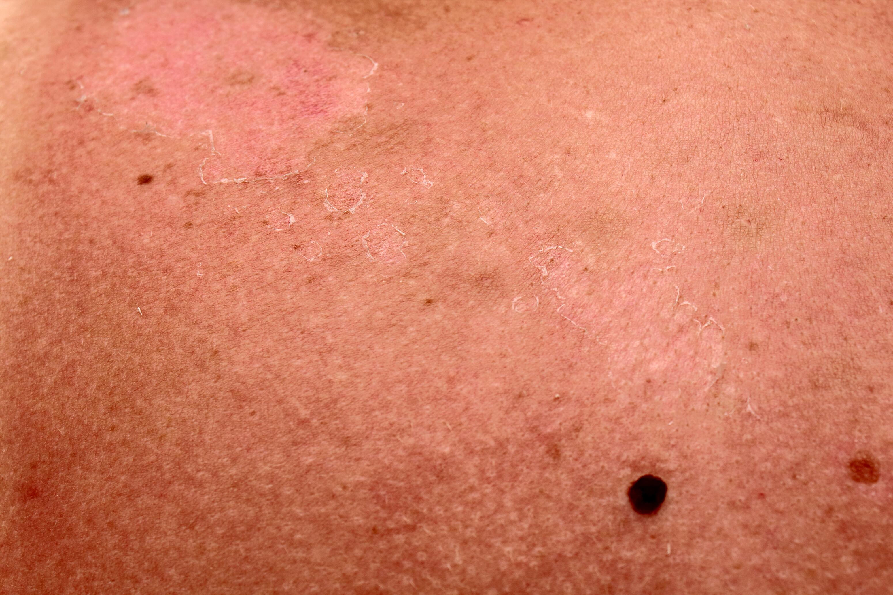 md_dexeryl_website-cancer-image_adobestock_445936845