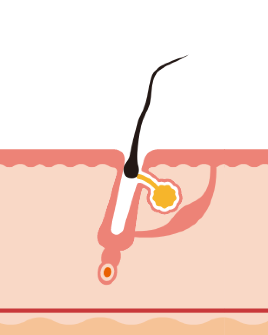 <p>Et enfin, la phase de chute (dite t&eacute;log&egrave;ne) qui dure 3 &agrave; 6 mois.</p>

