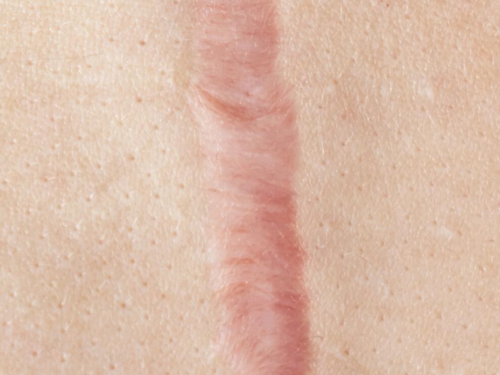 AD_EPITHELIALE_SILO_HEALING_L3_HYPERTROPHIC-SCARS