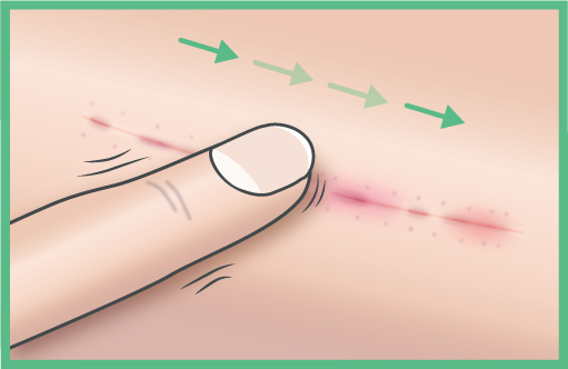 <p><strong>Cicatrices no maduras: APLICAR DELICADAMENTE</strong></p><p>Comienza aplicando el tratamiento suavemente sobre la cicatriz y la zona circundante, ejerciendo una suave presi&oacute;n. A continuaci&oacute;n, extiende en la direcci&oacute;n de la cicatriz.</p>

