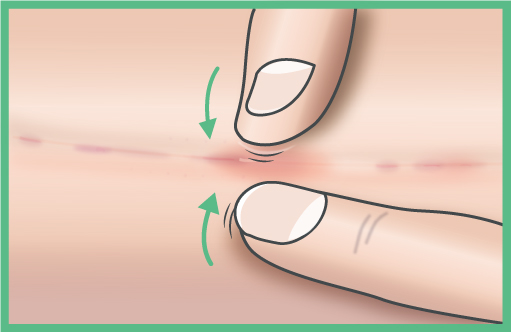 <p><strong>Cicatriz en proceso de maduraci&oacute;n: AMASAR Y MASAJEAR</strong></p><p>Pellizca suavemente la piel entre el pulgar y el &iacute;ndice, haciendo rodar el pliegue hacia arriba y en la direcci&oacute;n de la cicatriz hasta que el producto de cuidado haya penetrado (unos 5 minutos).</p>

