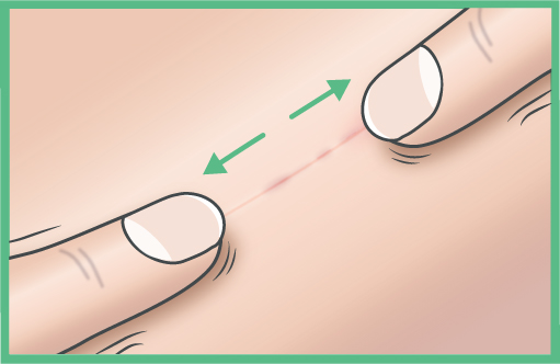 <p><strong>Cicatriz madura: ESTIRAR</strong></p><p>Estire la cicatriz con los dedos &iacute;ndice y coraz&oacute;n, siempre en la direcci&oacute;n de la cicatriz, hasta que el producto de cuidado haya penetrado (unos 5 minutos).</p>

